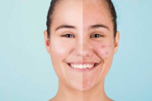 Donna acne prima e dopo