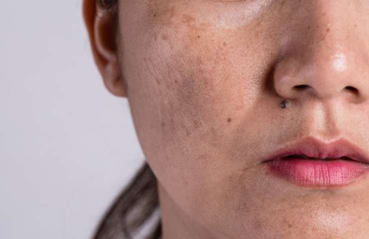 donna con pelle macchiata da acne
